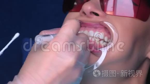 护士在牙科中应用凝胶进行LED美白女性患者牙齿，特写。