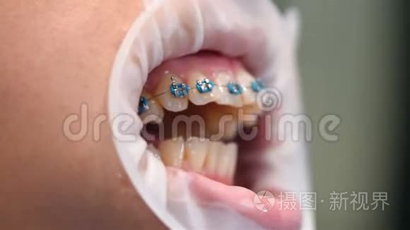 病人展示牙齿