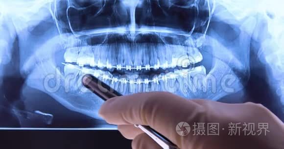 口腔医生用牙套分析牙片视频