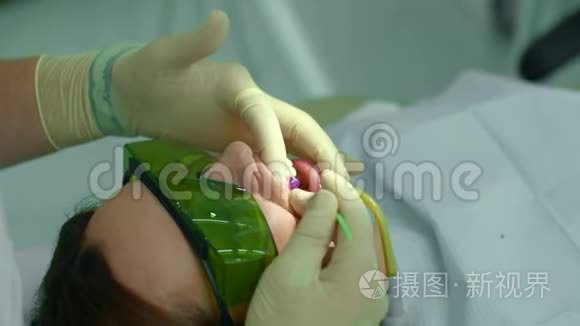 牙医用牙棒抚平物质视频