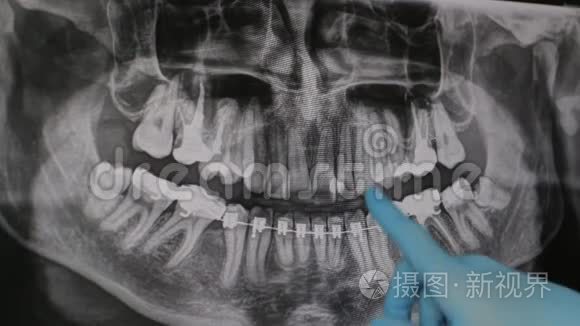 医生在监视器上显示了颌骨x光的治疗方案。