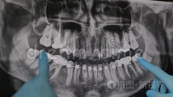 医生在监视器上显示了颌骨x光的治疗方案。