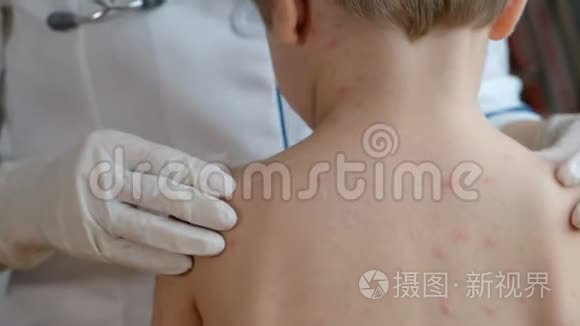 医生检查婴儿`的皮肤是否有水痘引起的水泡、疤痕和皮疹
