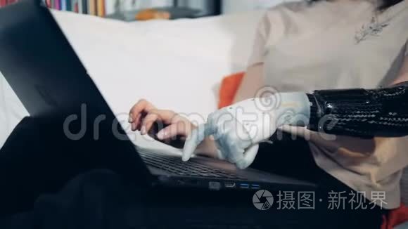女孩用假肢在笔记本电脑上打字视频