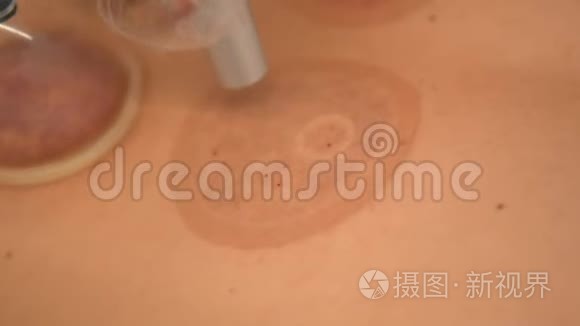 中国传统治疗特写视频视频