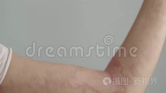 女人用皮炎抓她的手臂视频