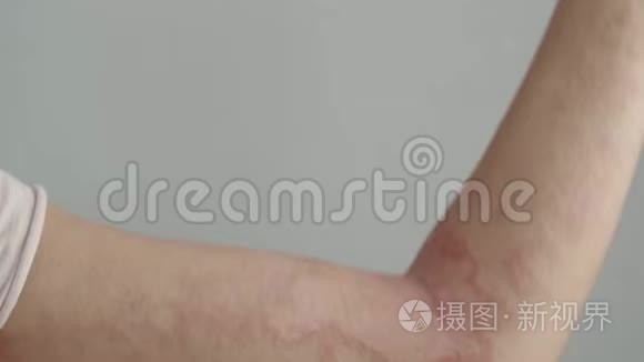 女人用皮炎抓她的手臂