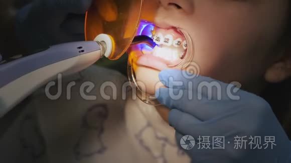 正畸医生用光聚合物灯照在牙齿上
