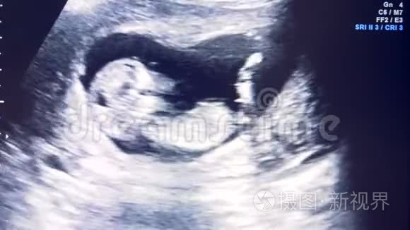 胚胎发育过程显示在监视器上的声像图
