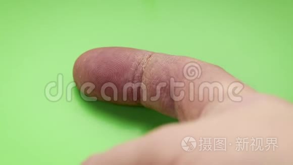手部护理。 干燥的皮肤，食指指骨上的裂缝