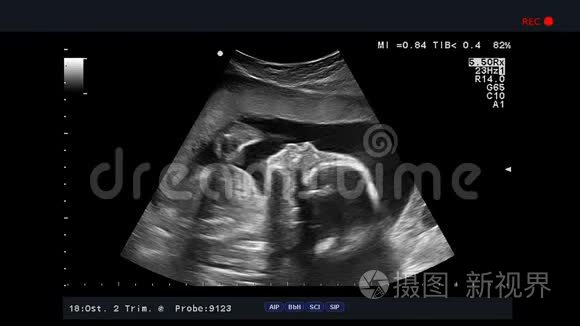 超声检查，胎儿在子宫里