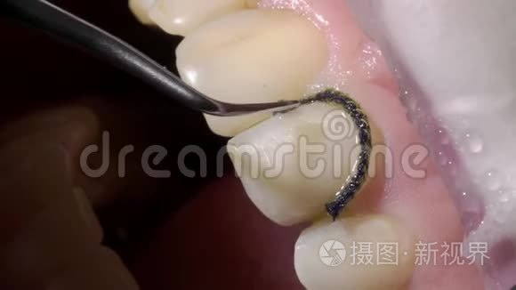 牙科医生做牙科整形视频