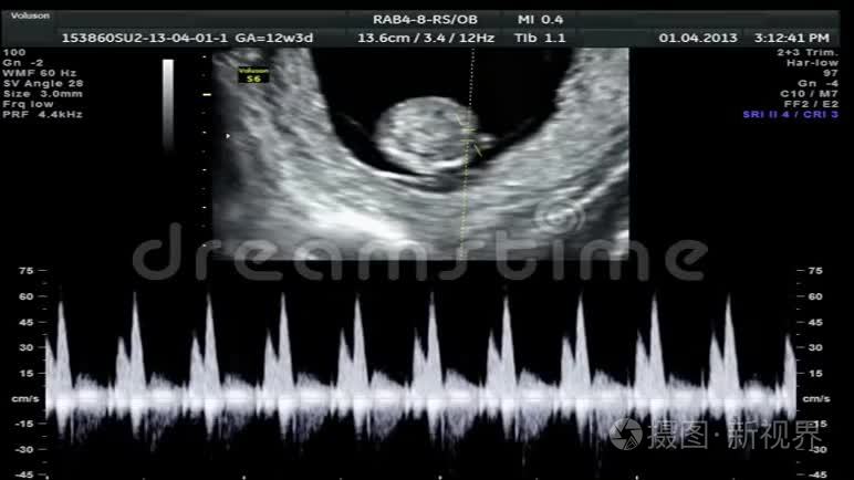 婴儿超声波扫描视频