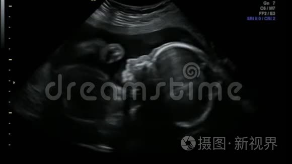 看看如何进行4d超声检查婴儿扫描
