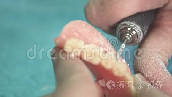 牙科用石膏制成的牙科种植假体视频