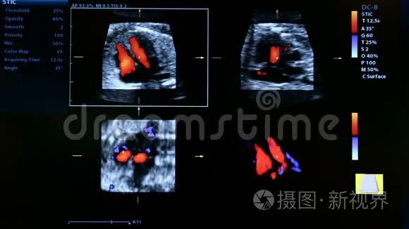 怀孕超声波监视器的彩色镜头