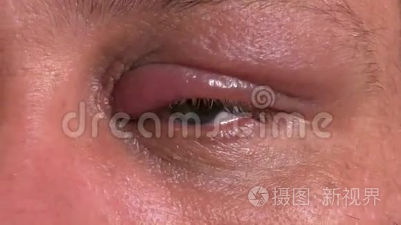 眼睛受感染的人短视频