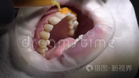 牙科医生为女性病人做牙齿美白视频