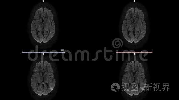 磁共振成像硬化脑微中风白斑视频