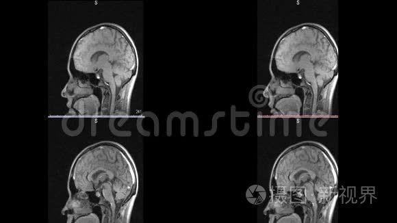 脑硬化微中风白斑的磁共振成像视频