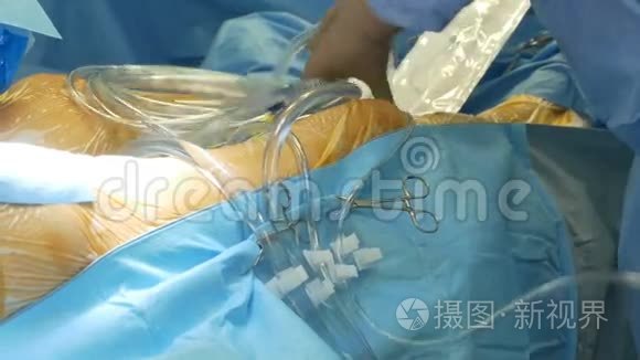安排手术引流管视频