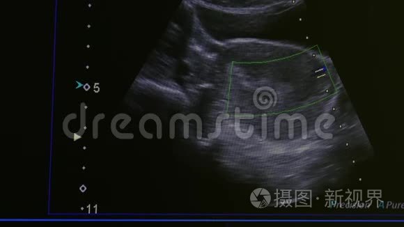 监测超声检查设备上的女性子宫图像。