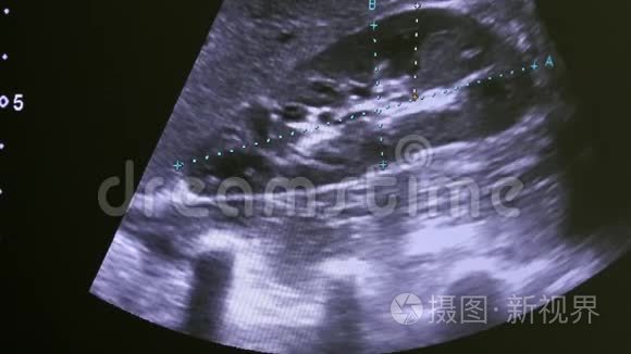 监测超声检查设备上的女性子宫图像。