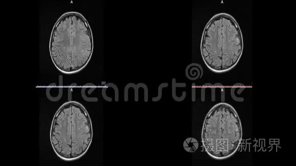 脑硬化微中风白斑的磁共振成像视频