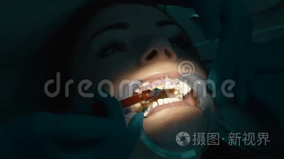 漂白凝胶在牙齿美白中的应用视频
