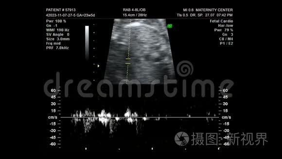 婴儿超声心电图视频